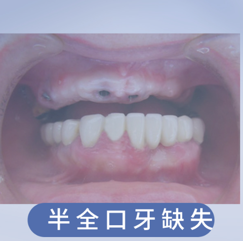 半全口牙缺失