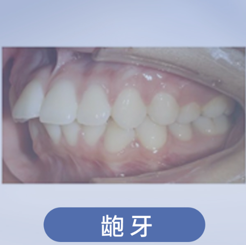 龅牙