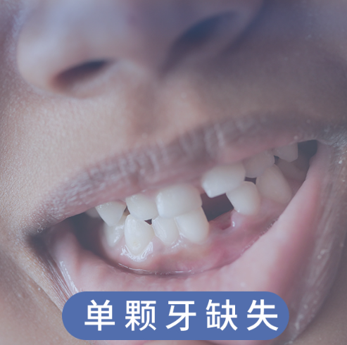 单颗牙缺失