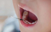 孩子乳牙未脱落，恒牙先长出来，怎么办？